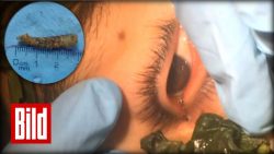 Ekel Operation - Ärzte holen Wurm mit Basilikum raus ekel operation aerzte holen wurm