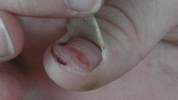 fingernagel hochklappen in hd