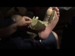 hornhaut am fuss abziehen