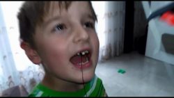 Zähne ziehen ganz xtreeem bei Kindern zaehne ziehen ganz xtreeem bei k