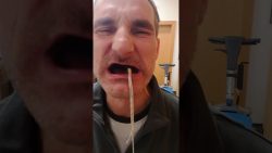 Zähne ziehen leicht gemacht - aber schmerzhaft zaehne ziehen leicht gemacht abe